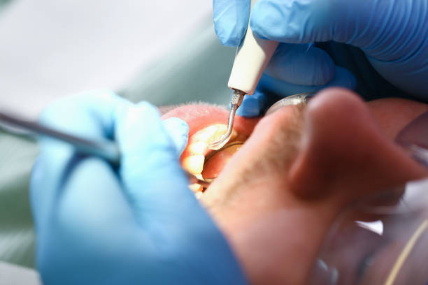 Best Emergency Dental Care for Broken or Chipped Teeth in Vassar, MI